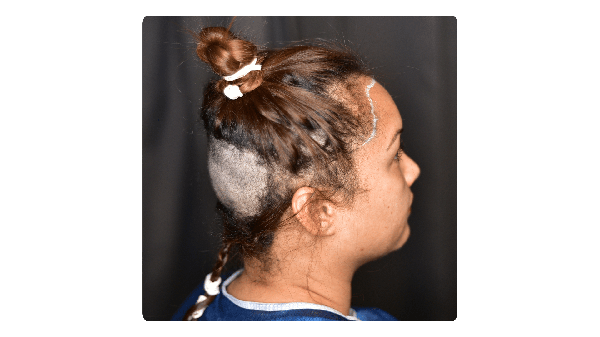 HAIR TRANSPLANTATION IN WOMEN | Long Hair Center | Long Hair Center HAIR TRANSPLANTATION IN WOMEN | Long Hair Center | Long Hair Center