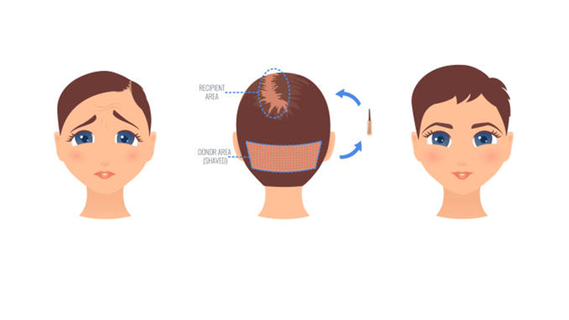 HAIR TRANSPLANTATION IN WOMEN | Long Hair Center | Long Hair Center HAIR TRANSPLANTATION IN WOMEN | Long Hair Center | Long Hair Center