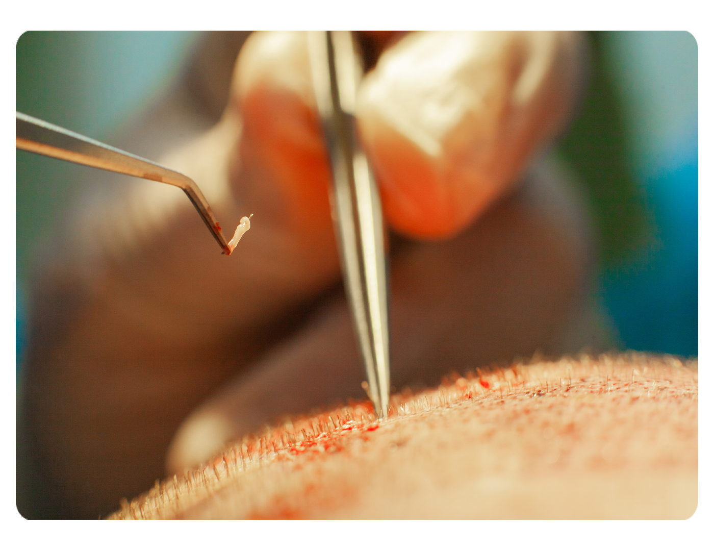 Implantation Process Image