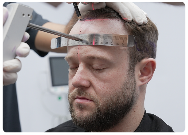 Natural Hair Transplant Image