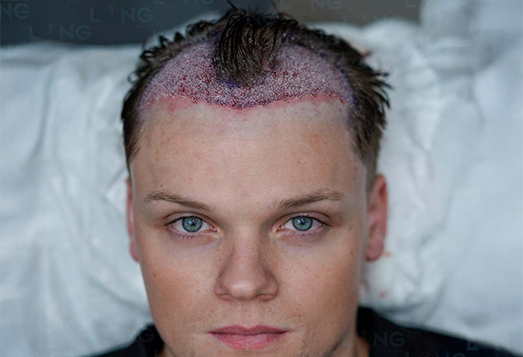 무삭발 모발 이식