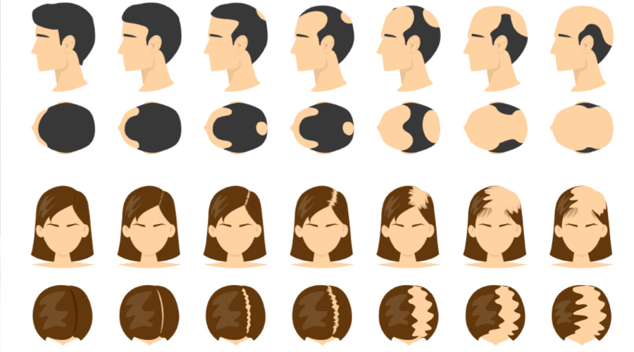 هل زراعة الشعر هي الطريقة الوحيدة لاستعادة الشعر؟