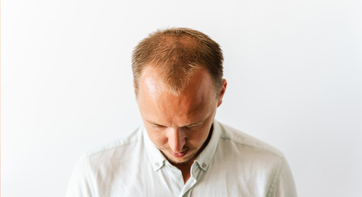 هل يجب إجراء عملية زراعة الشعر قبل استقرار تساقط الشعر؟