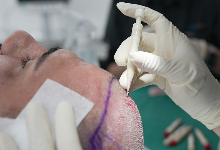 كيفية تصحيح عملية زراعة الشعر غير الناجحة: استراتيجيات المراجعة