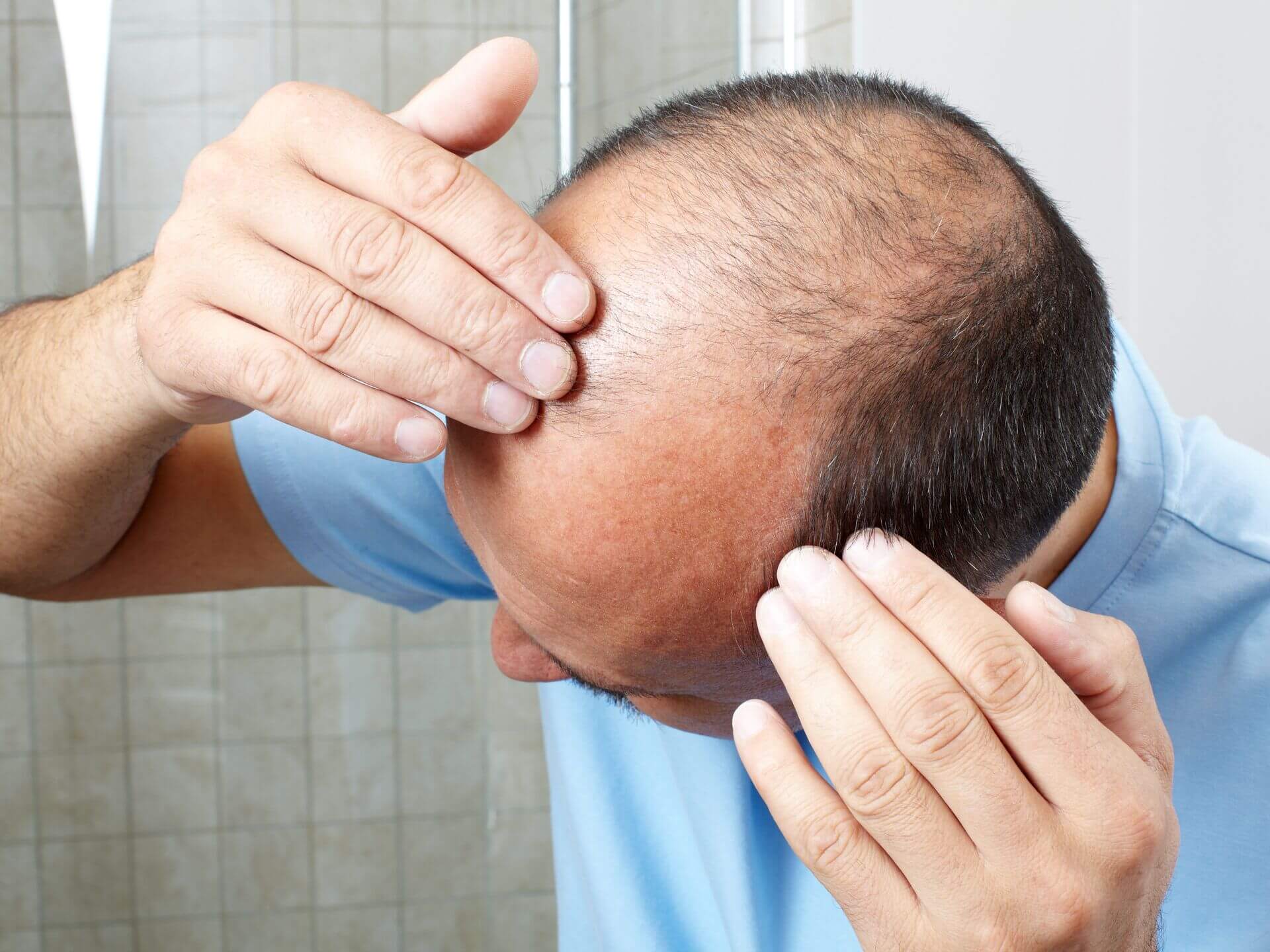 Why sex should be avoided after hair transplantation?
