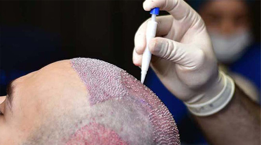 What to Expect After a Hair Transplant