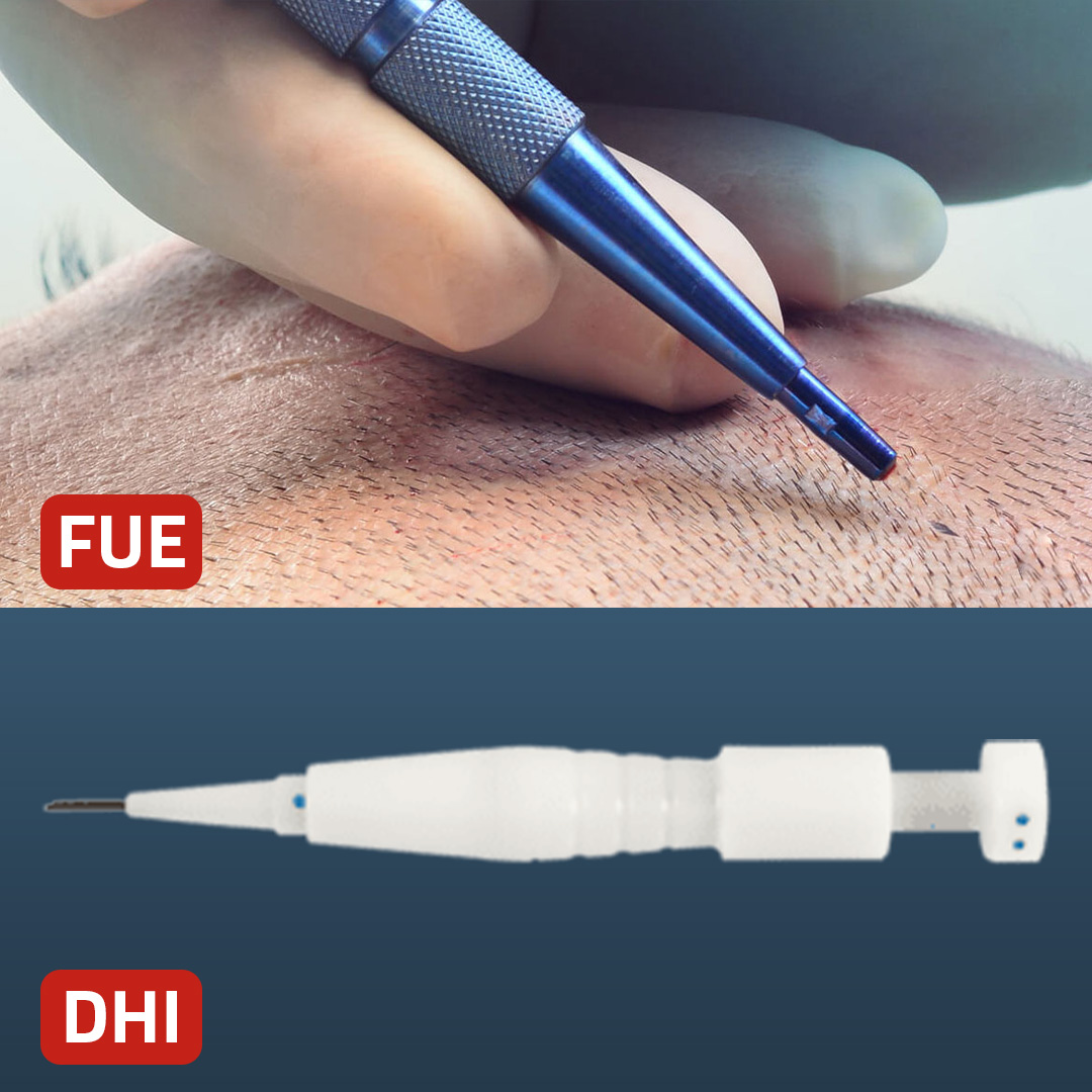 Is it possible to have both DHI and FUE hair transplants at the same time?