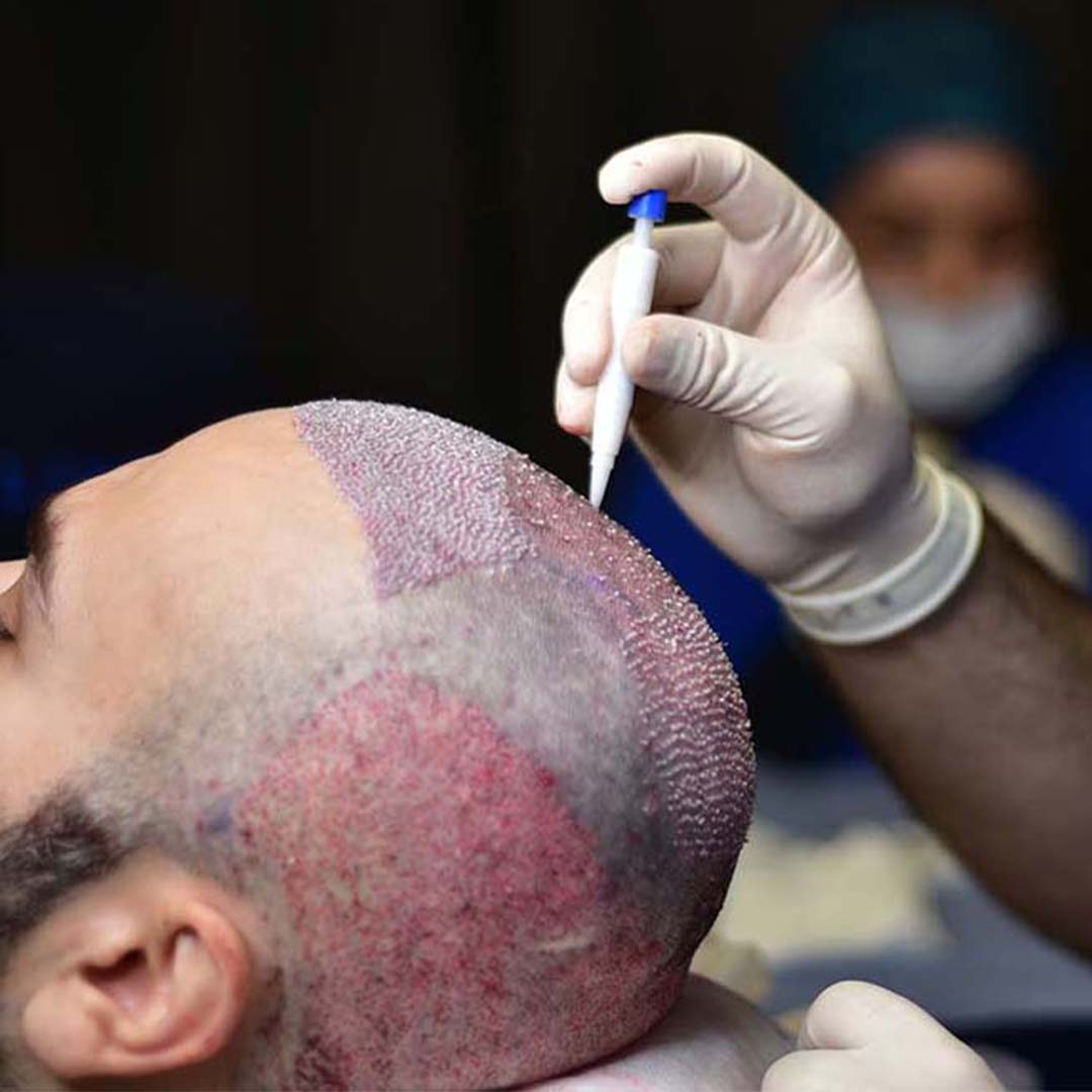What to Expect After a Hair Transplant