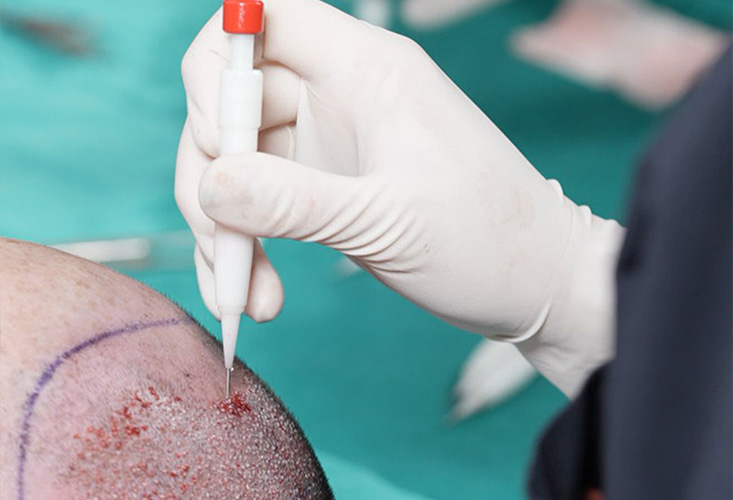 كل ما تحتاج معرفته حول زراعة الشعر: الآثار الجانبية والعملية والتفضيلات