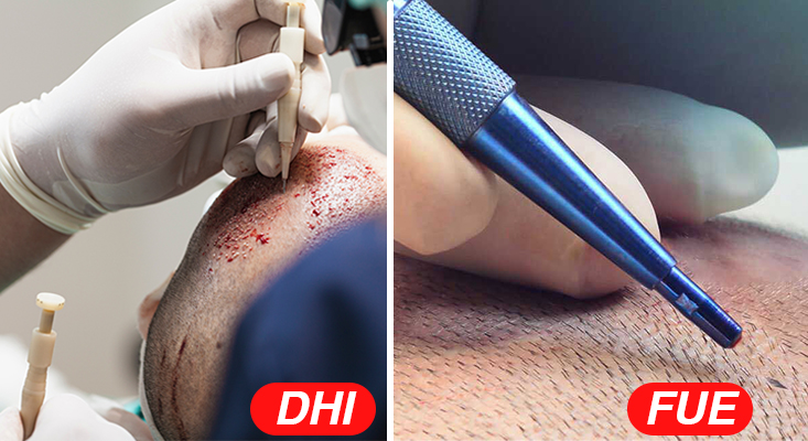 DHI(식모기) 와 FUE (비절개 사파이어) 모발 이식을 동시에 받을 수 있나요?
