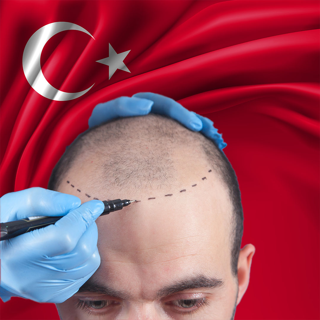 La Turquie est-elle une plaque tournante pour la greffe de cheveux ?
