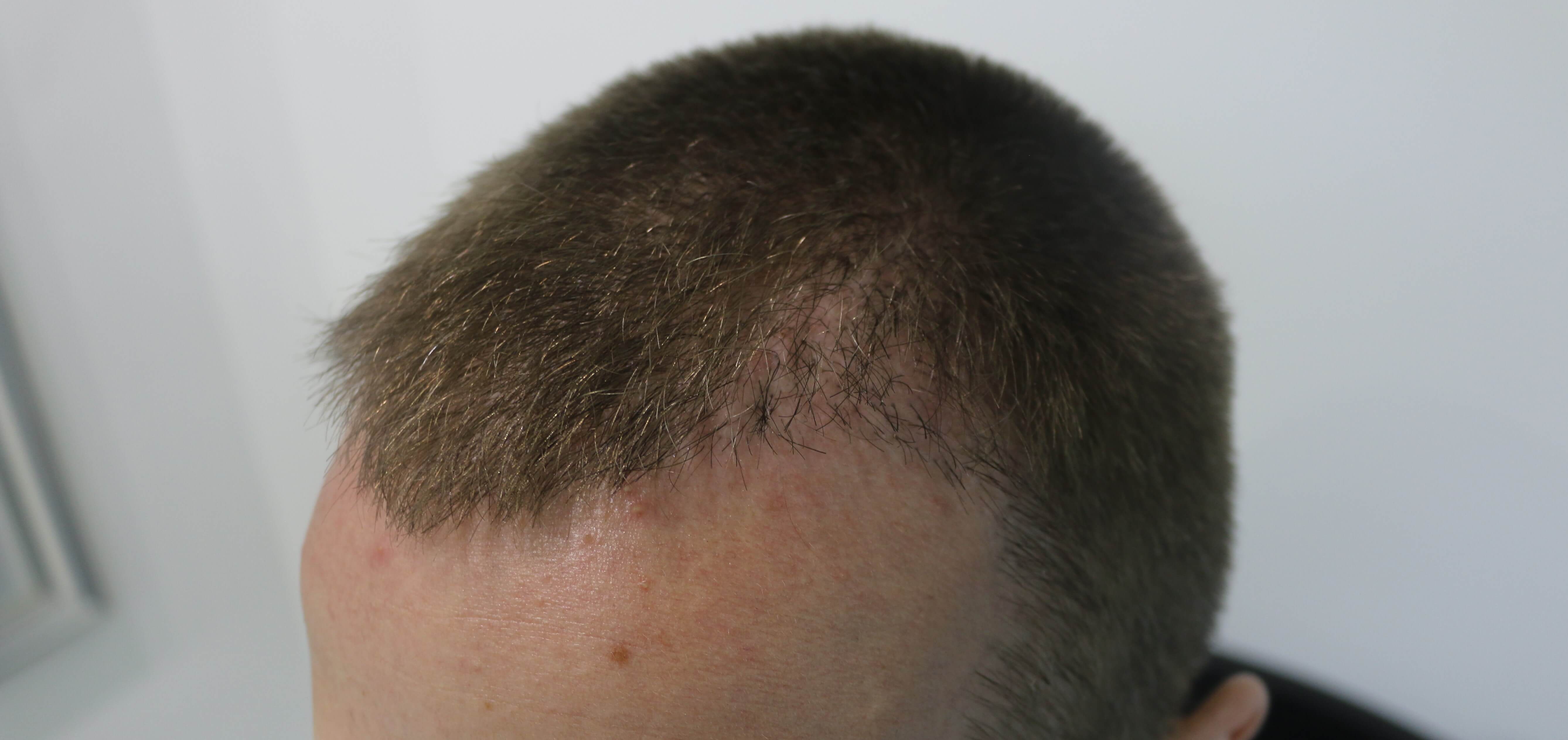 Hair Transplant Operation with DHI Technique in Turkey