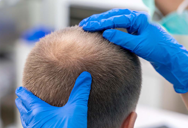 هل ستكون عمليات زراعة الشعر في منطقة التاج ناجحة؟