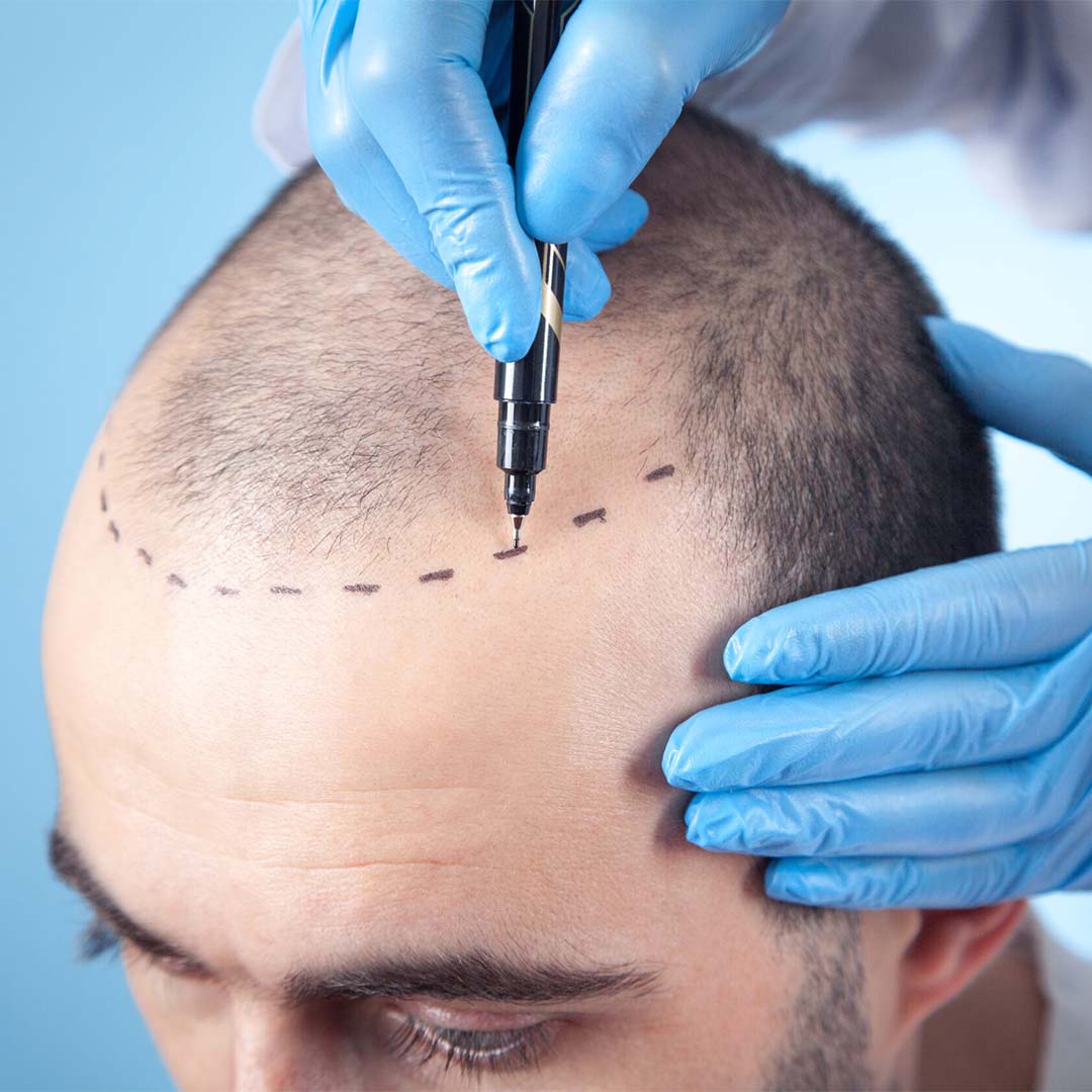 Age Factor In Hair Transplant
