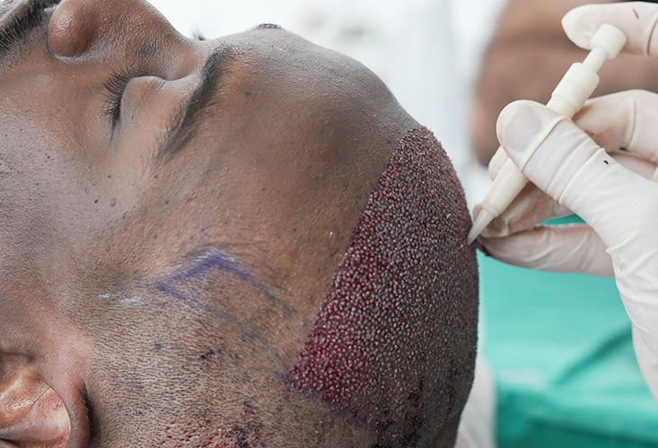 هل من الممكن تصحيح عملية زراعة شعر سابقة خاطئة / سيئة / تالفة؟